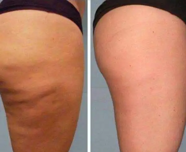Anti Cellulite